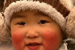 宝宝脸上红红的,宝宝脸上红红的原因及应对策略