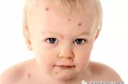 皮肤过敏喝豆腐脑好吗小孩子能吃吗,皮肤过敏者可适量食用，儿童适宜与否需注意